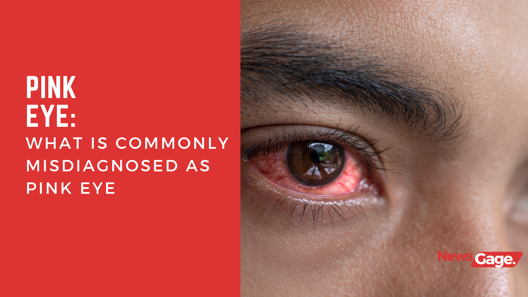 What is Commonly Misdiagnosed as Pink Eye